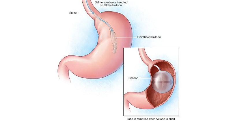 بالون معده