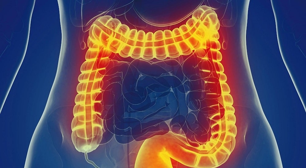 علائم سندروم روده تحریک پذیر