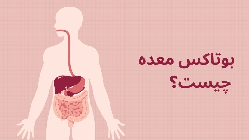 بوتاکس معده چیست؟