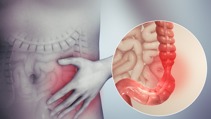 ibs چیست